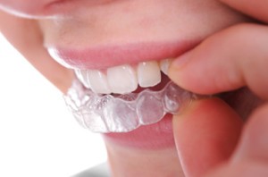 Mengenal Manfaat dan Jenis Kawat Gigi