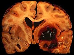 Penyebab dan Gejala Perdarahan Otak