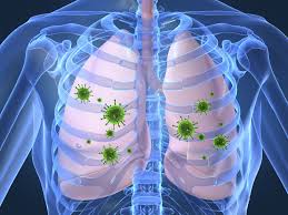 Jenis-Jenis Bakteri Penyebab Pneumonia